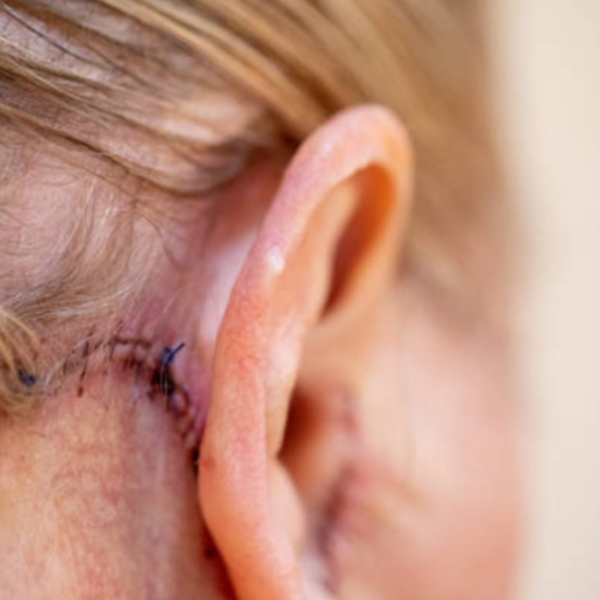 results of ear correction surgery