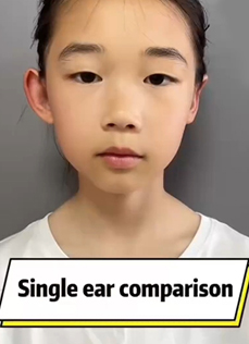 Baby Ear Corrector Patch YuMeBeauty